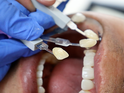 Restauration en composite